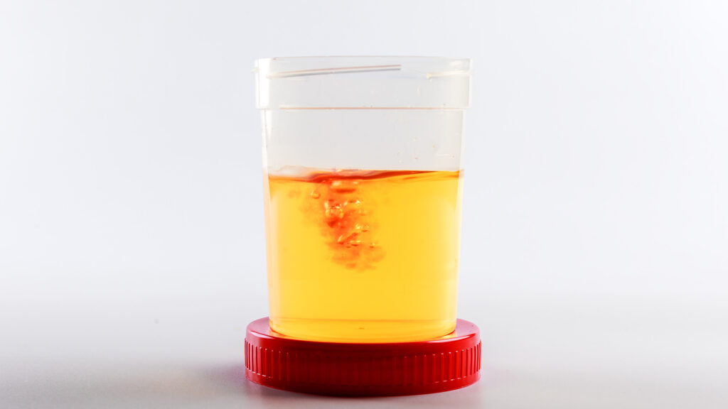 Urine infection in children