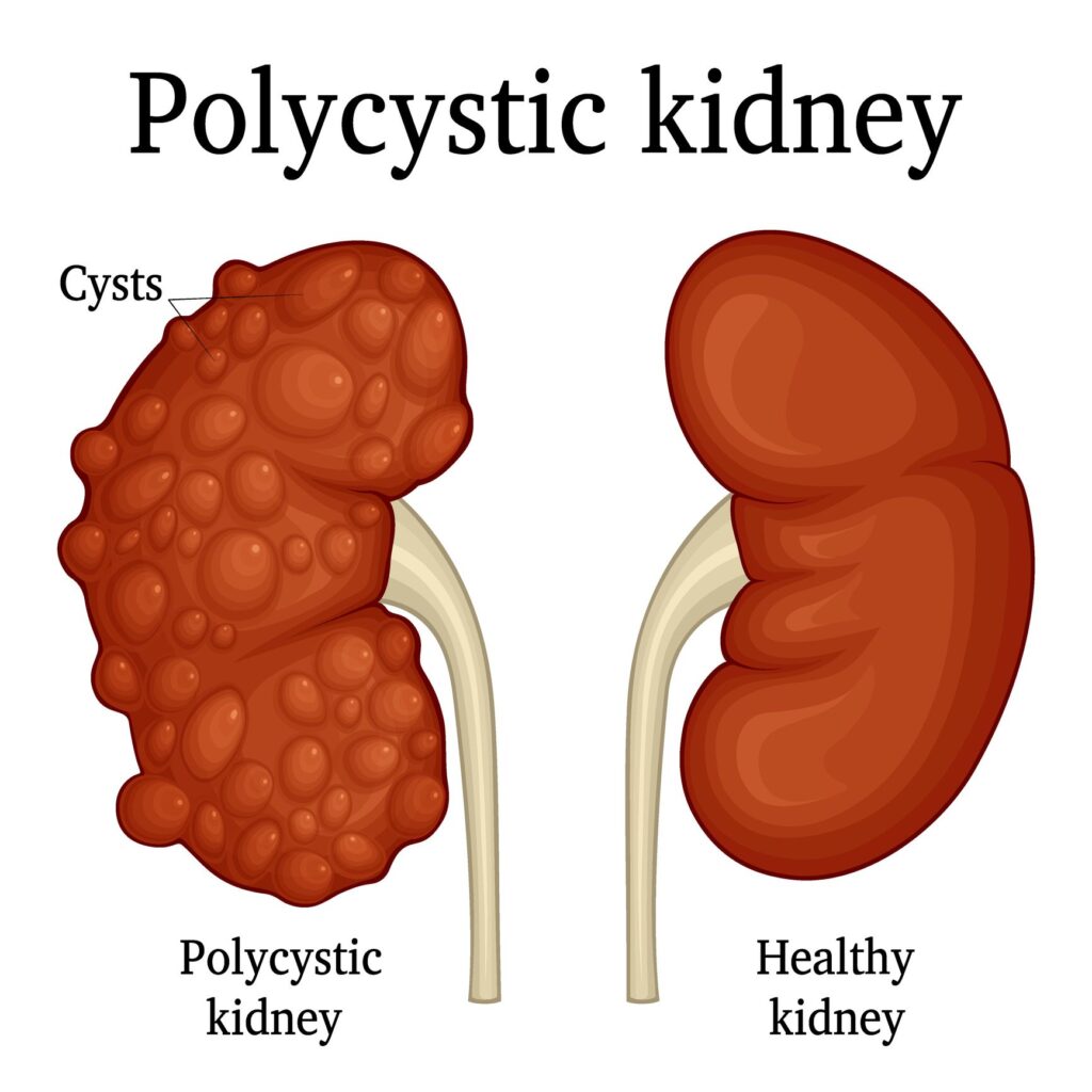 Child Kidney Specialist Pune