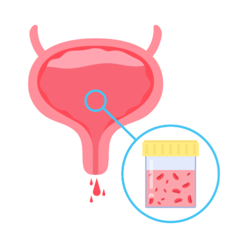 Blood in urine / hematuria treatment